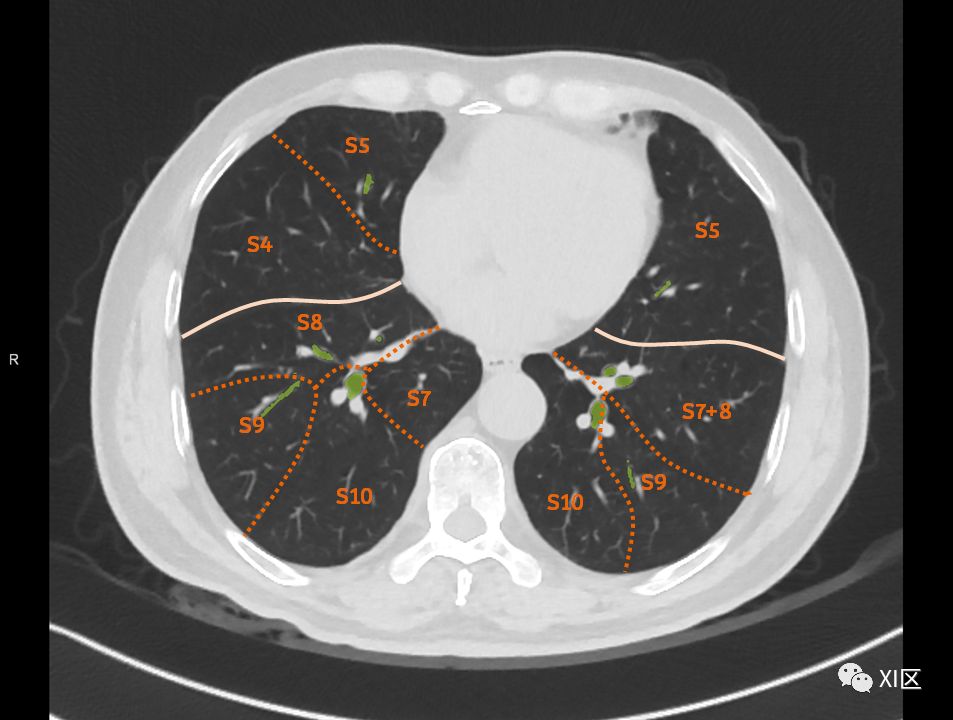 如此详细的肺部影像解剖，有点儿酷！