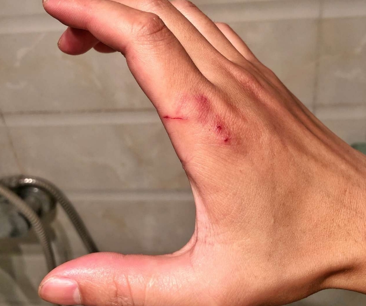 浙江一男子钓鱼差点被鱼拉下水,男子钓鱼被鱼咬后续