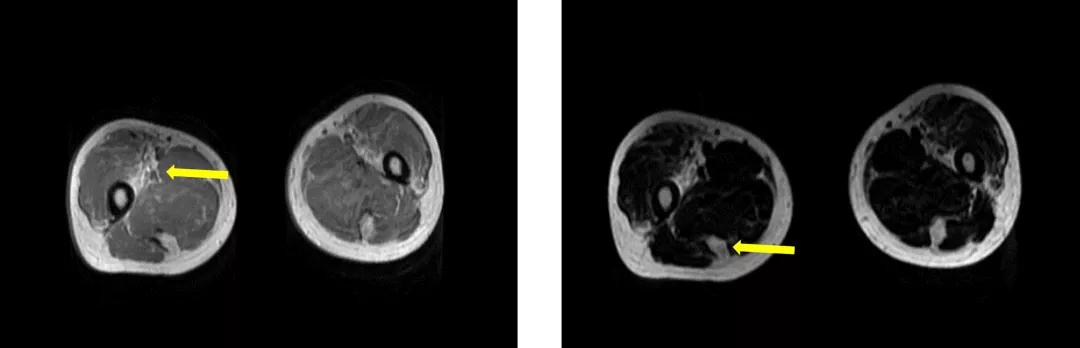重度高碳酸血症突出表现,出现消化系统疾病的临床表现