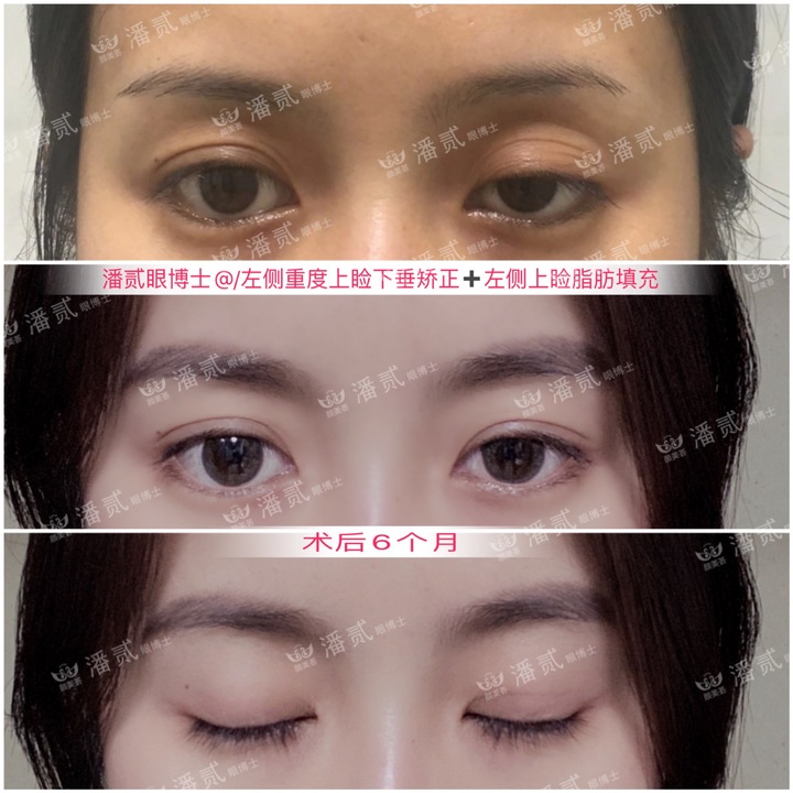 重度上睑下垂术后为什么闭不上眼睛？闭眼不全怎么护理好？