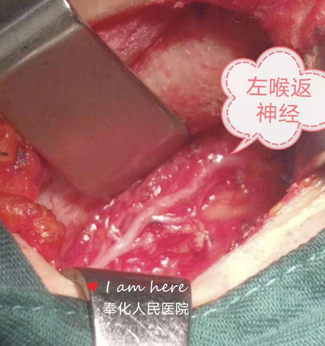 甲状腺肿瘤术后注意事项,甲状腺消融术后注意事项