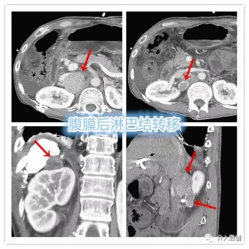 肝癌腹膜后淋巴结转移是怎么回事,肝癌腹腔淋巴结转移瘤意味着什么