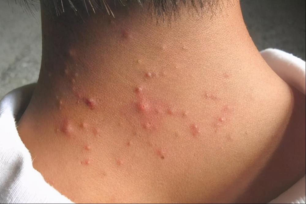 疮长在肛门旁边怎么治疗,后背长疮怎么治疗好得快