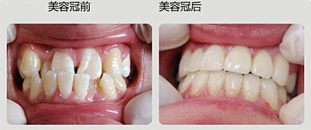 美容冠修复在哪里可以做,美容冠修复