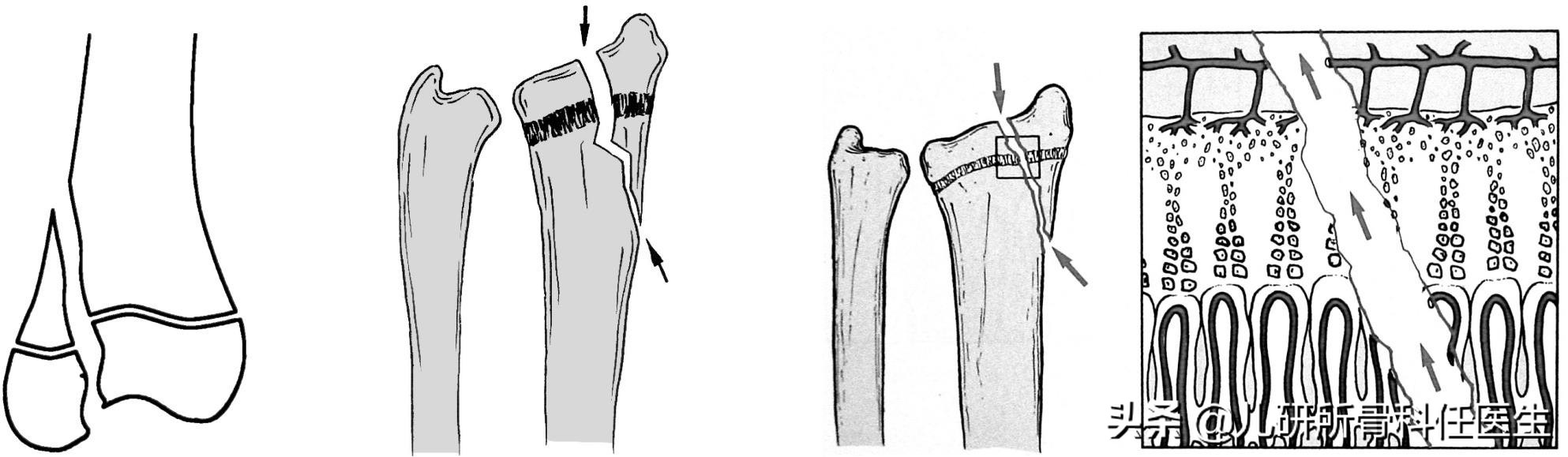 孩子走路太早对腿有什么伤害,宝宝站立早会罗圈腿吗
