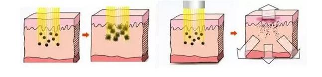 激光美白皮肤大概需要多少钱,私密激光美白多久能见到效果