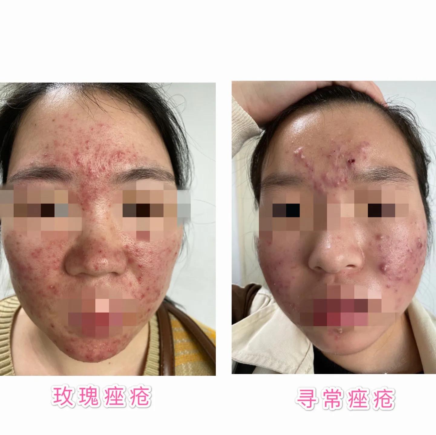 过敏脸上身上全是红痘痘,脸红就是玫瑰痤疮吗