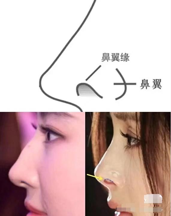 盘点一些有问题的鼻子,明星都没整好的鼻子