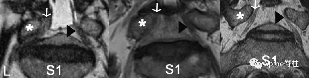 下肢疼痛是腰椎间盘突出引起的吗,下肢放射痛查不出原因