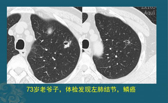 新冠肺部感染应对,新冠肺癌抗癌