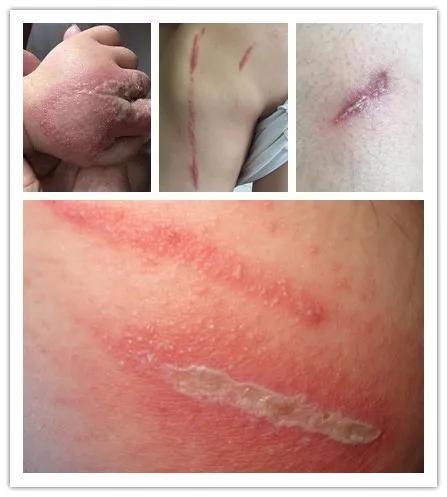 夏季人虫大作战！拍死它，隐翅虫皮炎就来了