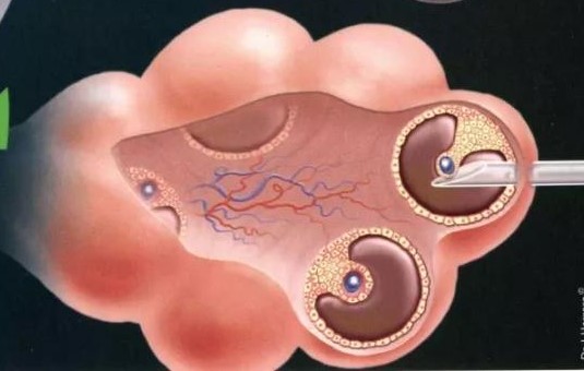取完卵后腹胀腹痛几天能消失,取完卵腹胀腹痛怎么办