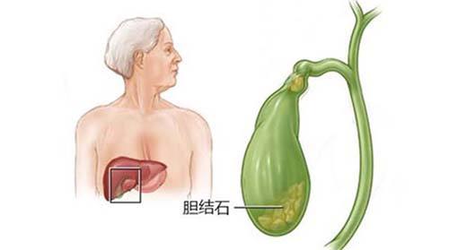 溶解胆结石的药有哪些,体检发现胆结石需要治疗吗