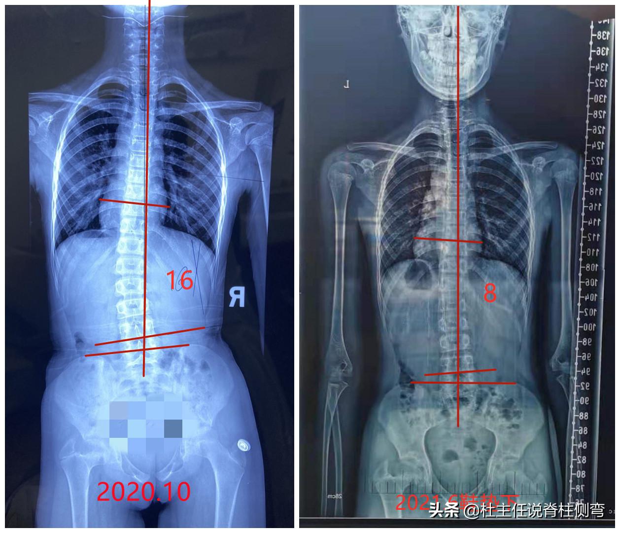 结构性脊柱侧弯怎么治疗,长短腿造成的脊柱侧弯怎么矫正