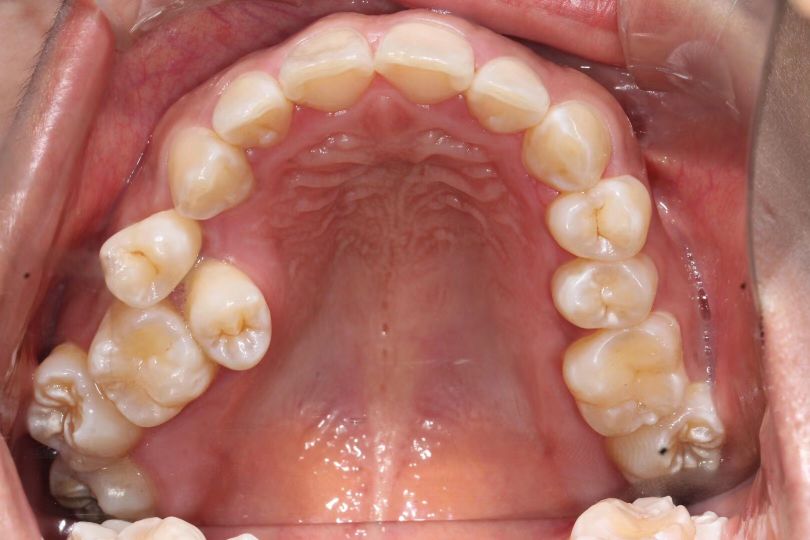 看牙矫正一般去哪里看,矫正牙齿的全套流程