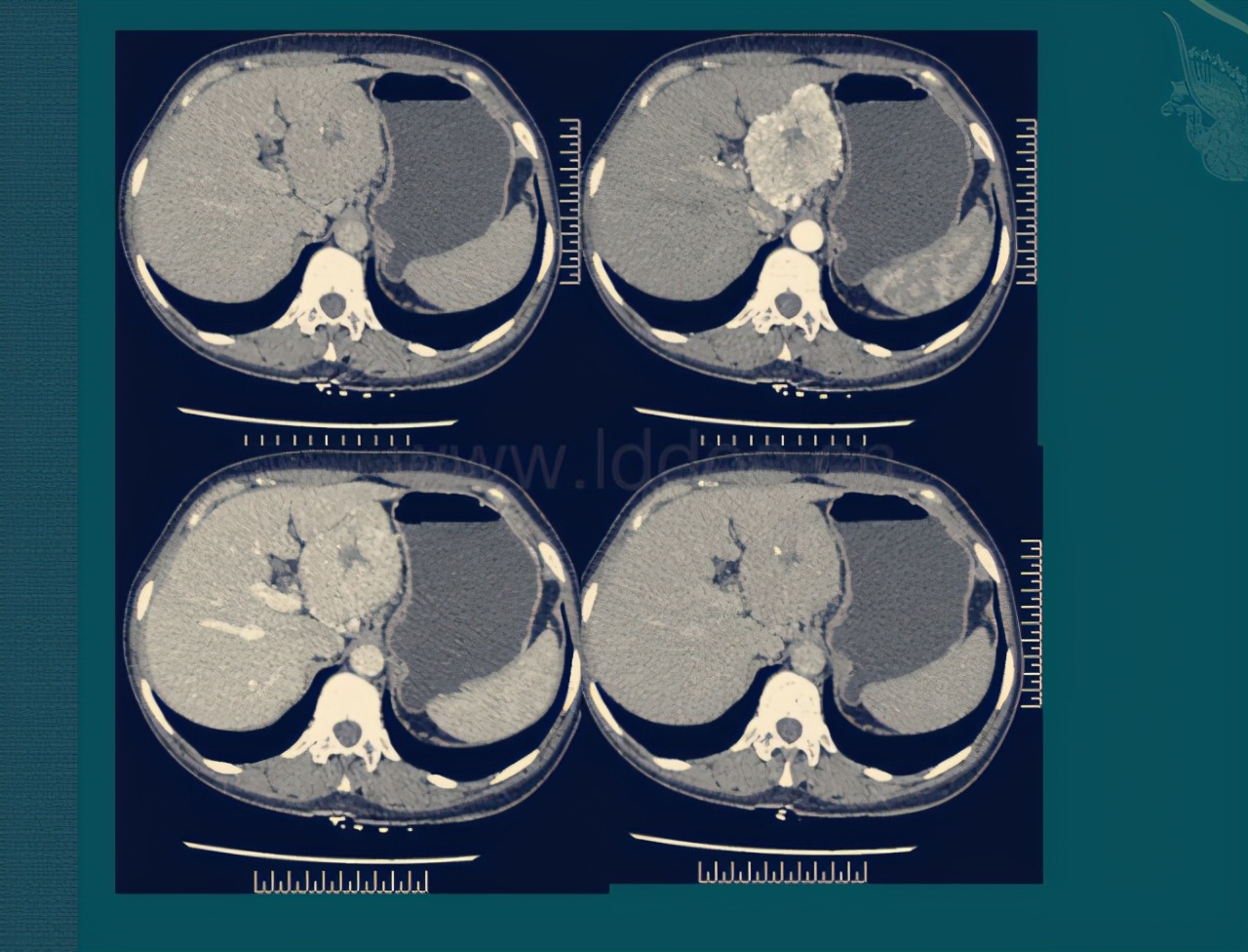 妈妈胃癌手术2年体重一直上不去,妈妈患了胃癌