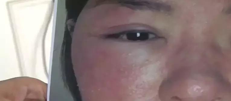 威海医院美容科祛斑,威海环翠区美容祛斑