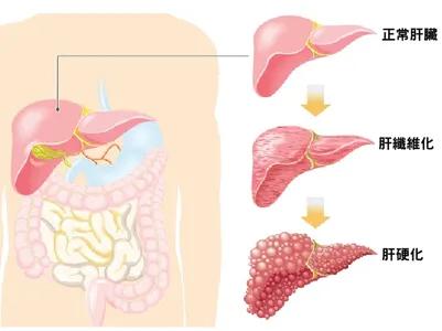 白蛋白球蛋白比值偏低怎么治疗,肝硬化白蛋白和球蛋白的关系