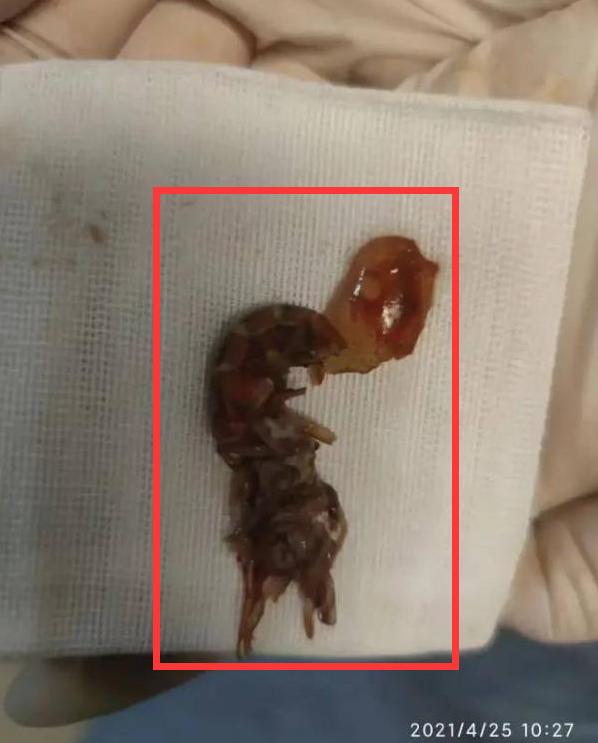 “医生救我！小龙虾越爬越凶！”浙江14岁男孩把小龙虾塞进肛门！称想把活龙虾变成龙虾干？