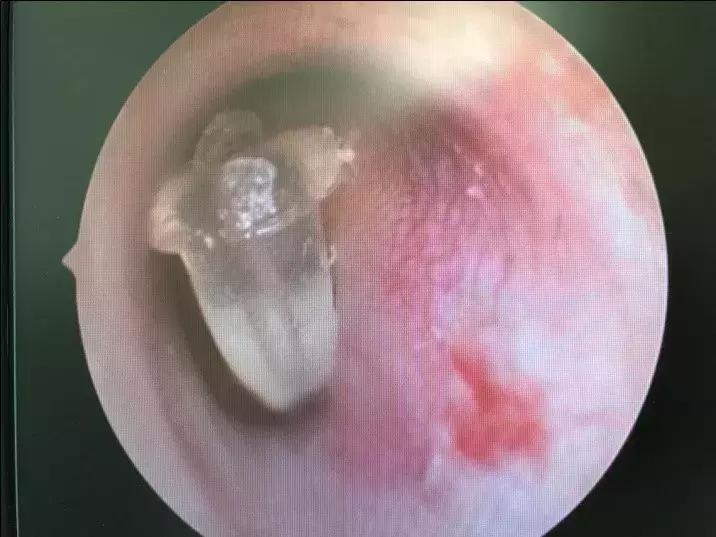 耳朵里长肉芽什么感觉,耳朵里长个小肉芽怎么办