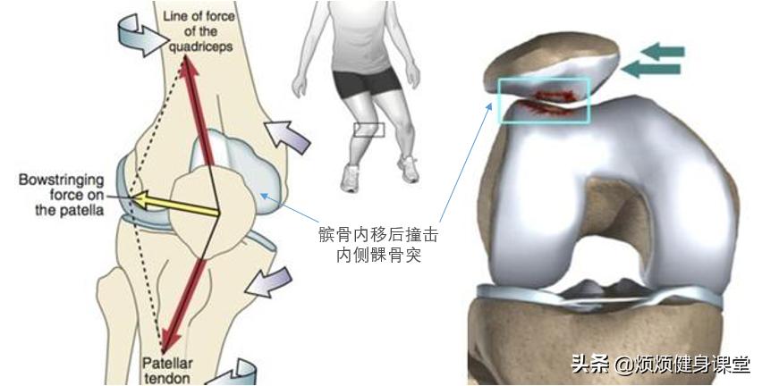 经期怎么改善膝盖内扣,干货教学如何改善膝盖内扣