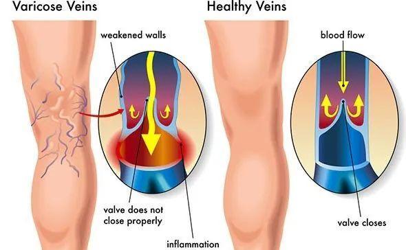 静脉曲张是什么？静脉曲张怎么预防？如何改善静脉曲张？