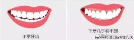 深覆合隐形牙套如何打开咬合,有连桥牙可以做隐形矫正吗