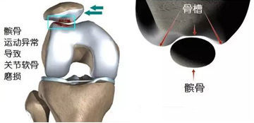 髌骨软化髌上囊积液怎么治疗,髌骨软化导致膝盖炎症