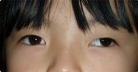 经常眯眼睛看东西眼睛会变小吗,为什么老是眯眼