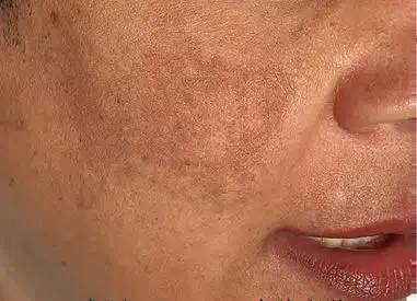 斑点美白最有效的正品祛斑霜,女士抗皱祛晒斑雀斑霜