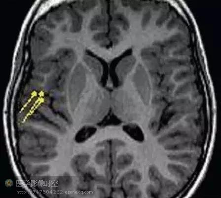 儿童癫痫CT表现,儿童各类癫痫脑电图特征