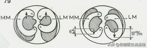 膝内侧半月板1-2级损伤,半月板的作用及损伤后怎么修复