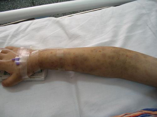 身上青紫是不是其它病的前兆,上半身青紫常见于哪种疾病