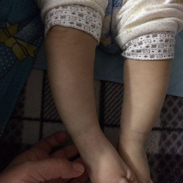 五个月宝宝的腿罗圈,五个月宝宝罗圈腿可以矫正吗