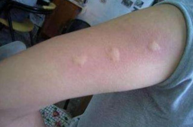 怎么防蚊子叮宝宝小技巧,夏天宝宝总被蚊子叮有什么好办法