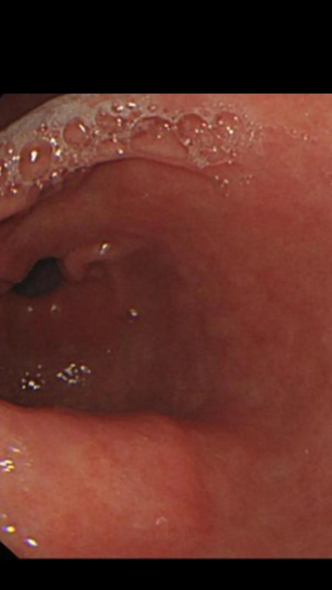 急性胃炎的症状及治疗方法,急性胃炎分类