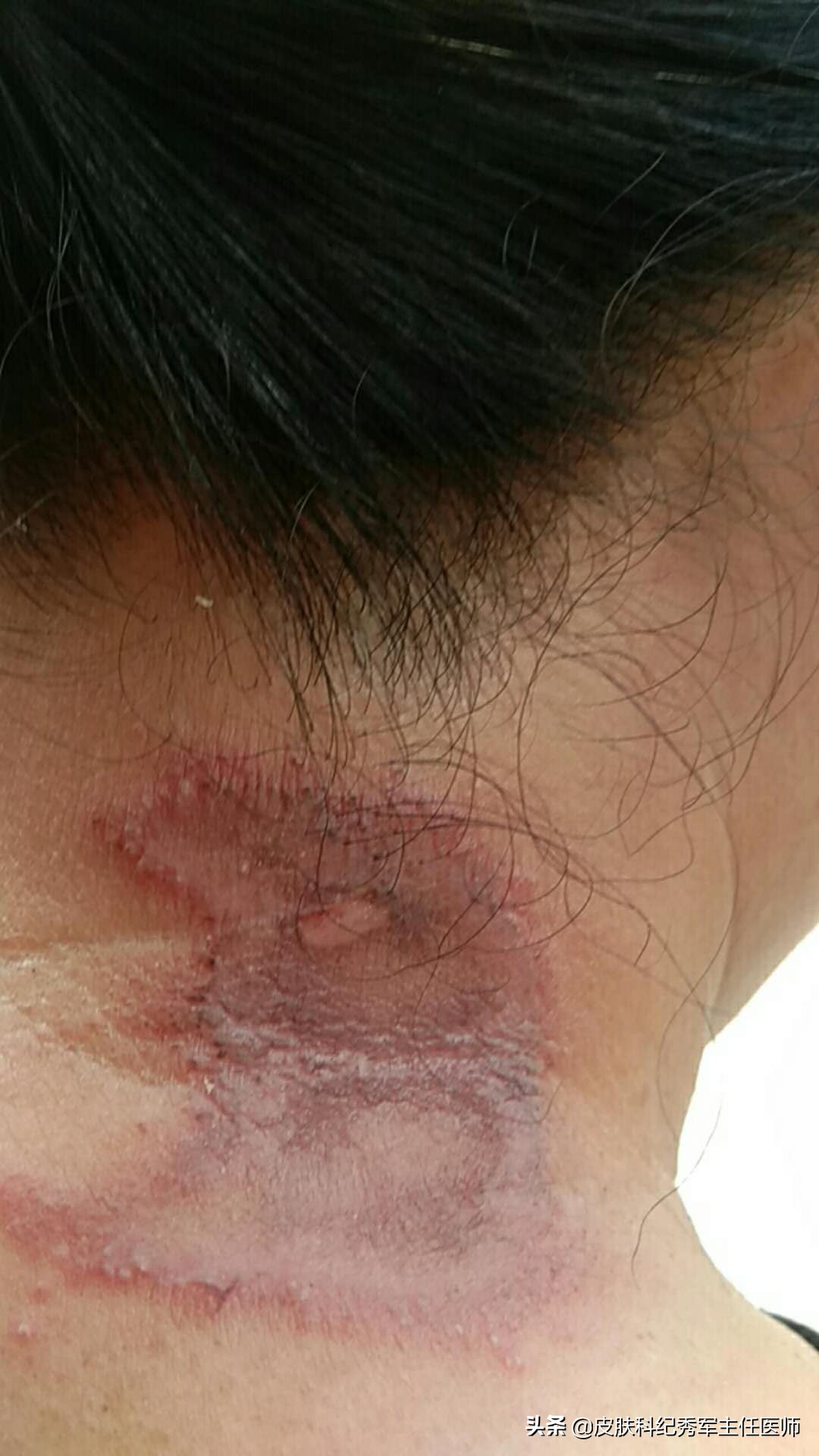 隐翅虫皮炎怎么判断严重,隐翅虫皮炎症状注意事项