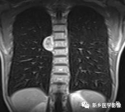 胸腺增生和纵隔肿瘤的区别和症状,纵隔胸腺肿瘤的常见临床症状表现