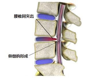 腰椎间盘突出有药酒可以治吗,腰椎间盘突出有药缓解吗
