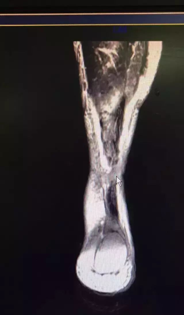 运动医学分析运动损伤案例,运动医学跟腱撕裂