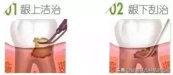 如何预防和治疗牙周炎,矫正完怎么预防牙周炎