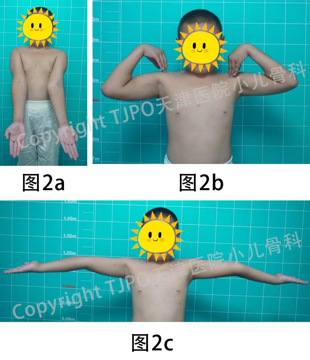 肱骨髁上骨折如何预防肘外翻畸形,肱骨髁上骨折外翻畸形原因