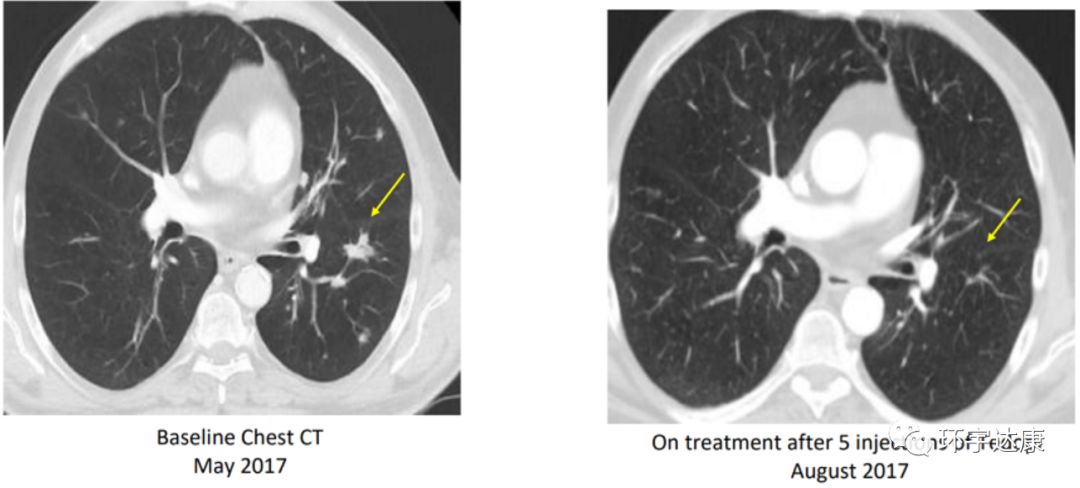 pd1耐药后又生效,PD-1耐药机制