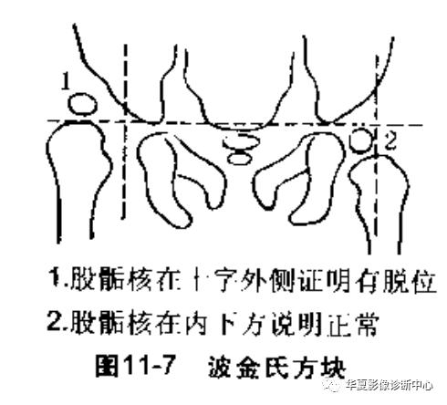 先天性髋关节脱位饮食,先天性髋关节脱位属不属于残疾人