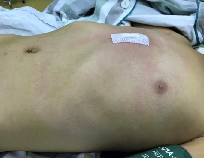 先天漏斗胸手术,少年漏斗胸手术