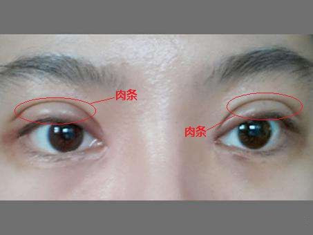 怎样修复双眼皮线条,上海修复肉条双眼皮哪里做的好