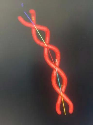 淄博市中心医院治疗动脉瘤,tubridge动脉瘤支架医保报销多少