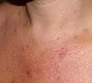 粉刺是什么应该怎么治,粉刺怎么样才算好了