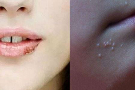 老年人嘴角烂是什么原因,小孩子嘴角烂是什么原因