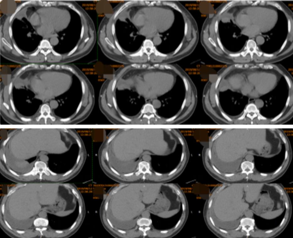 56岁男性发现双肺,56岁男性发现双肺数百个结节